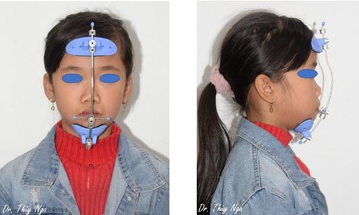 Khí cụ chỉnh hình Facemask để kéo xương hàm trên ra trước